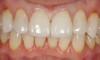 Fig 11. The definitive restorations for tooth Nos. 8 and 9 are tried in and evaluated individually for marginal fit, as well as for collective fit and tightness of proximal contacts.