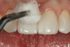 Fig 14. Marginal excess is removed gently with a cotton pellet, with care taken not to cause movement of the restorations.