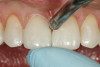 Fig 15. A stream of air is blown from the facial aspect of the gingival embrasures on both sides of the restorations to help remove cement excess from the interproximal areas.