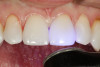 Fig 19. The definitive restorations are fully light cured per manufacturer’s instructions.