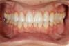 Fig 22. A full retracted facial view of the completed restorations.