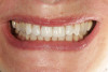 Fig 23. A full smile view of the completed restorations. Note the perfect esthetic match to the natural teeth.