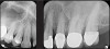 Fig 2. Left: PSP vertical PA radiograph of
maxillary bicuspid area demonstrating full root structure, several millimeters of bony anatomy beyond apices and maxillary sinus. Tooth No. 4 may be
traumatized as periodontal ligament is widened. Right: PSP horizontal PA radiograph of maxillary bicuspid area. Tooth No. 12 shows widened apical
periodontal ligament presumably caused by deep restorative filling. Some loss of supporting bone is evident interproximally, especially pronounced
between tooth Nos. 14 and 15.