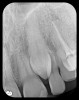 Fig 7. Presence on maxillary
anterior PSP PA radiograph of impacted canine No. 11.