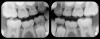 Fig 14. Bilateral BW PSP radiographs on this 8-year-old patient
demonstrate agenesis of bicuspid Nos. 20 and 29. Primary tooth Nos. K
and T must be evaluated for long-term retention.