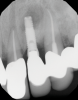 (1.) Preoperative radiographic evaluation demonstrating a large radiolucency at the apical third of the body of an implant fixture replacing the patient’s maxillary left lateral incisor. The implant was stable, and the prosthesis was deemed esthetically acceptable by the patient.