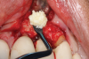 (7.) Allograft was firmly packed around the implant body without crushing the material.