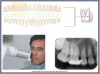 Figure 22 – Maxillary Premolars