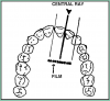 Figure 40 – Maxillary Central/Lateral Incisors