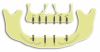 Fig 1. Ideal implant positions for dual-arch overdenture patients. In the maxillary arch, ideal positions are the first/second molars, first/second premolars, and lateral incisors. In the mandibular arch, ideal positions are the first molars and canines.