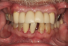 Fig 2. Patient presented with a failing dentition due to extensive periodontal disease and was interested in full-mouth reconstruction with dental implants.