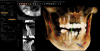 Fig 3. After a CBCT scan was made, virtual implants were placed in widely distributed positions on the maxillary (six implants) and mandibular (four implants) arches.