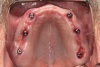 Fig 4. Maxillary overdenture abutments were placed.