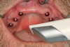 Fig 7. Denture housings were placed onto each abutment and optically scanned using an intraoral scanner.