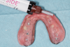 Fig 10. Denture housings were placed onto each abutment and recesses prepared within the prostheses. Composite resin was placed into each recess and the prosthesis placed onto the edentulous ridge. After complete polymerization, the prostheses were removed.