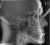 Fig 6. Cephalometric x-ray of patient.