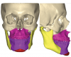 Fig 8. Virtual surgical planning with surgical computer programs can be used to increase precision and predictability in the 3-dimensional correction of the deformity.