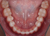 Fig 7. Intraoral occlusal views of the maxillary (Fig 6) and mandibular (Fig 7) arches after tooth extractions and orthodontic treatment.