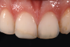 (6.) Pretreatment photograph of an existing composite restoration on tooth No. 8 that was placed 5 years prior to presentation following a traumatic injury. The patient was not satisfied with the esthetic appearance of the restoration.