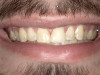 Fig 1. Extra-oral photography. All dental practices should provide the patient with the following four extra-oral photographs: the close-up smile (Fig 1), the retracted smile (Fig 2), the upper arch (Fig 3), and the lower arch (Fig 4).