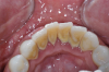 Fig 5. Intra-oral photography. Lower lingual anterior gingiva (Fig 5). Old restoration (Fig 6).