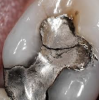 Fig 6. Intra-oral photography. Lower lingual anterior gingiva (Fig 5). Old restoration (Fig 6).