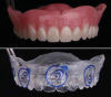 Fig 1. A complete denture (top) and its duplicate (bottom). (Note: The instrument holding the setups is not part of the denture or duplicate.)