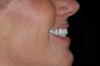 Fig 9. Flangeless denture tried-in showing importance of lip support in this case; facial view (Fig 8) and profile view (Fig 9).