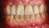 Fig 6. Final outcome at delivery of screw-retained milled ceramic crown restorations.