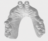 Fig 9. Presurgical proposed implant positions in digital scan with proposed scanbodies inserted to enable fabrication of screw-retained fixed provisional restoration prior to surgery.