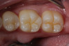 Fig 1. An occlusal view of teeth Nos. 29, 30, and 31 after micro-preparation with a Fissurotomy bur to remove decay diagnosed by quantitative light fluorescence (QLF).