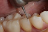 Fig 2. A Fissurotomy bur is used to remove decay found in the central groove of this mandibular premolar.
