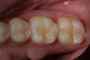 Fig 6. An occlusal view of the completed micro-preparations on the occlusal surfaces of teeth Nos. 29, 30, and 31 restored with Giomer flowable composite.