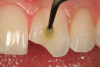 Fig 13. After placement of a bevel on the facial surface 2 to 3 mm from the position of the fracture, the enamel is etched and rinsed, and an adhesive resin is scrubbed into the prepared surface.