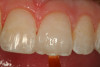 Fig 17. A white composite tint is placed with a sable brush to create a whitewashed appearance internally before placement of a clear enamel increment on top of it. This will allow the effect to show through in a similar fashion to those seen on natural teeth.