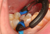 Fig 21. A Giomer bulk-fill paste-type composite is shown being placed with a composite placement instrument in the distal-occlusal cavity preparation on tooth No. 29.