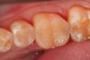 Fig 25. An occlusal view of the completed Giomer bulk-filled composite restorations on teeth Nos. 29 and 30.