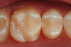 Fig 30. An occlusal view of the completed mesial-occlusal low-shrink Giomer composite restoration in tooth No. 3.