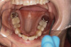 (2.) Narrow maxillary arch with deep palatal vault.