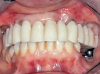 Fig 6. Frontal view after insertion of provisional restoration into the TIs and abutment teeth.