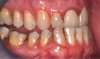 Fig 8. A class III adult male patient required surgical orthodontic treatment. The patient had anterior and posterior crossbites and required leveling of a deep curve of Spee during presurgical orthodontics.