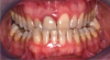 Fig 9. A class III adult male patient required surgical orthodontic treatment. The patient had anterior and posterior crossbites and required leveling of a deep curve of Spee during presurgical orthodontics.