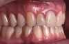 Fig 18. Bite interdigitation to finalize surgical orthodontic correction. After orthodontics, periodontal plastic surgery, bleaching, microabrasion, and restorative dentistry were performed.
