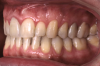 Fig 20. Bite interdigitation to finalize surgical orthodontic correction. After orthodontics, periodontal plastic surgery, bleaching, microabrasion, and restorative dentistry were performed.