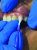 (6.) Fluoride varnish is one of the most common dental products used to help protect vulnerable tooth surfaces.