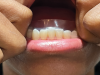 (9.) Dissolvable whitening strips are a desirable option for use as a patient motivator and adjunctive therapy.