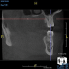 (6.) A lateral cyst associated with tooth No. 12 was asymptomatic and misdiagnosed on a periapical radiograph, but it was correctly diagnosed thanks to this CBCT slice of the maxilla that isolates the lesion.