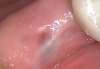 (2.) Preoperative occlusal view of the implant fixture covered by overgrown tissue.