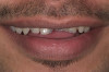 Figure 4  Preoperative smile view.