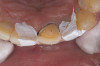 Figure 10  Tooth No. 9 with no preparation on the palatal surface to restore lost form with bonding resin.